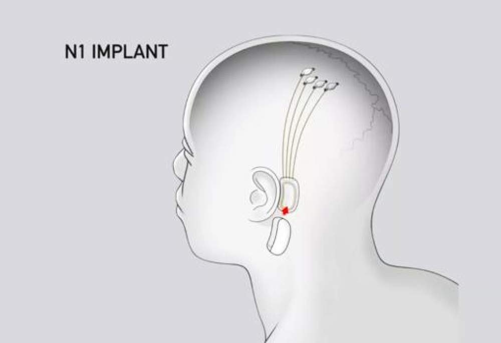 Así funciona Neuralink